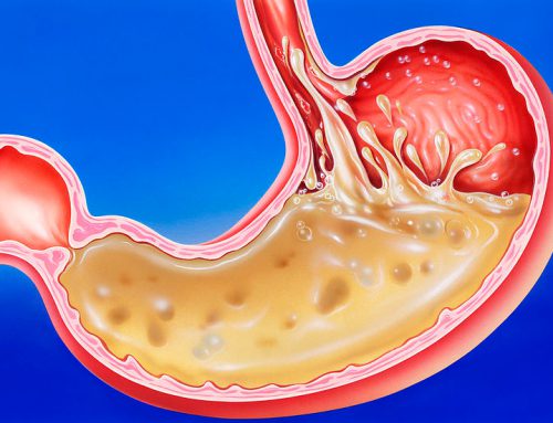 Γαστροοισοφαγική Παλινδρόμιση